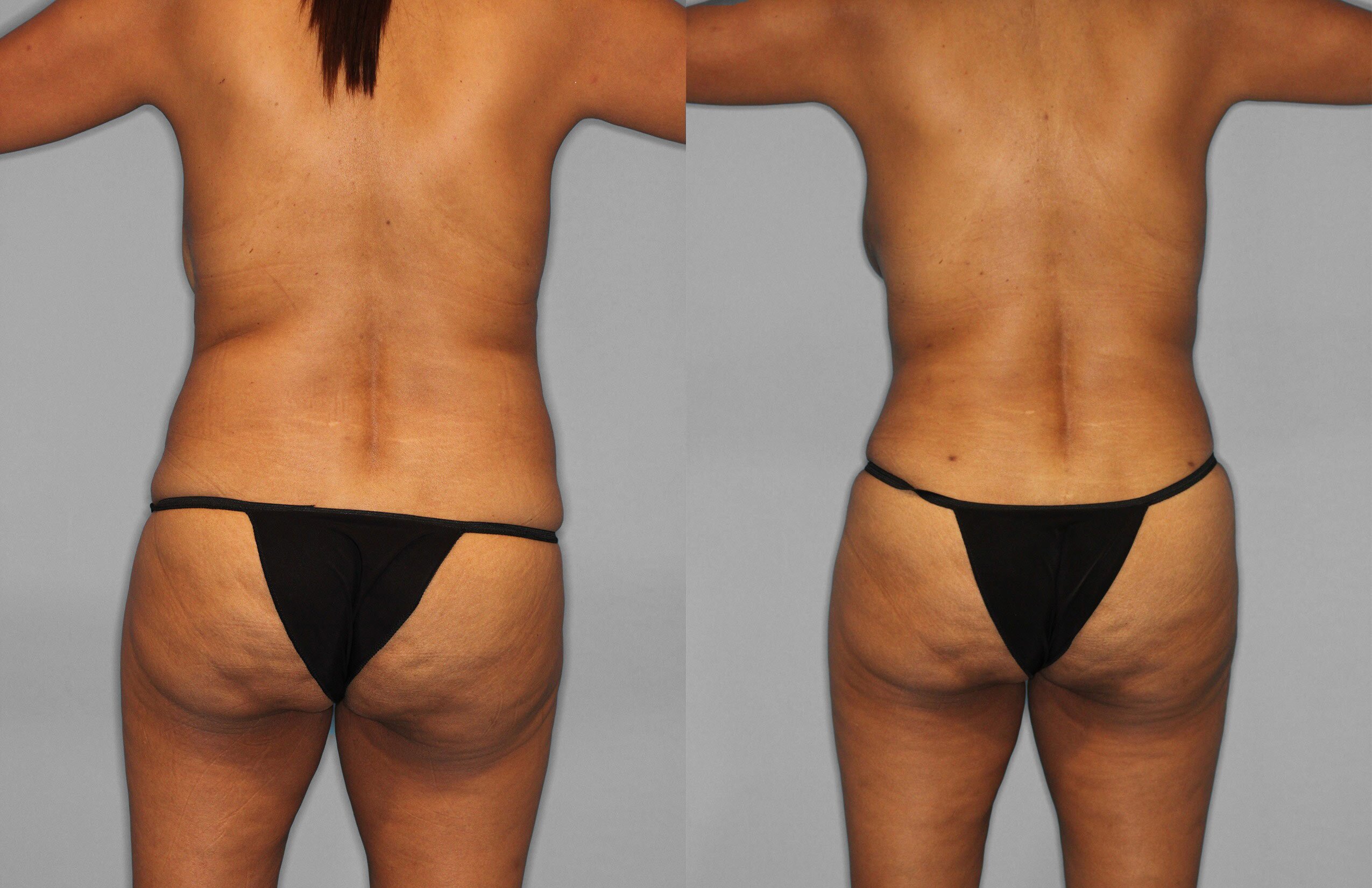 Tummy Tuck Before and After photo by Dr. Abigail Rodriguez in Houston, TX