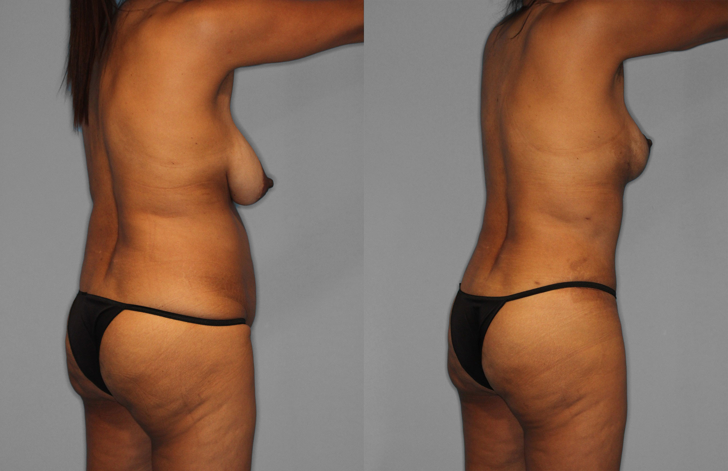Tummy Tuck Before and After photo by Dr. Abigail Rodriguez in Houston, TX