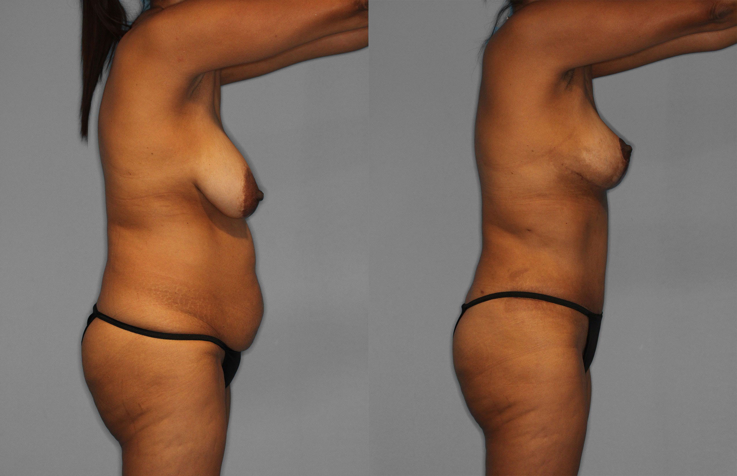 Tummy Tuck Before and After photo by Dr. Abigail Rodriguez in Houston, TX