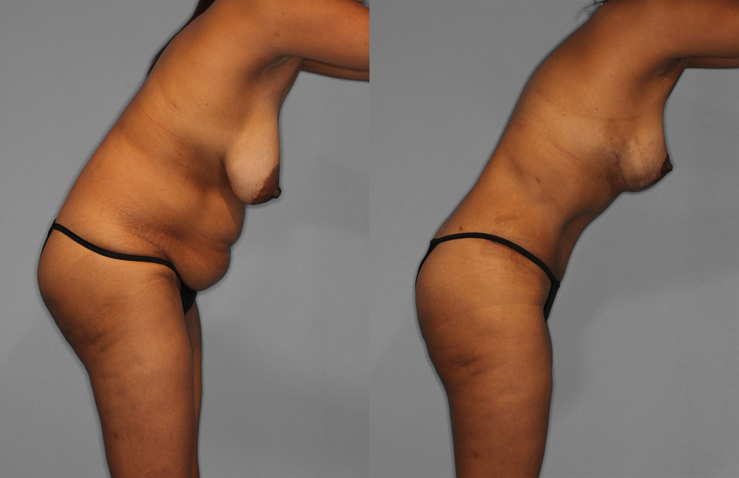 Tummy Tuck Before and After photo by Dr. Abigail Rodriguez in Houston, TX