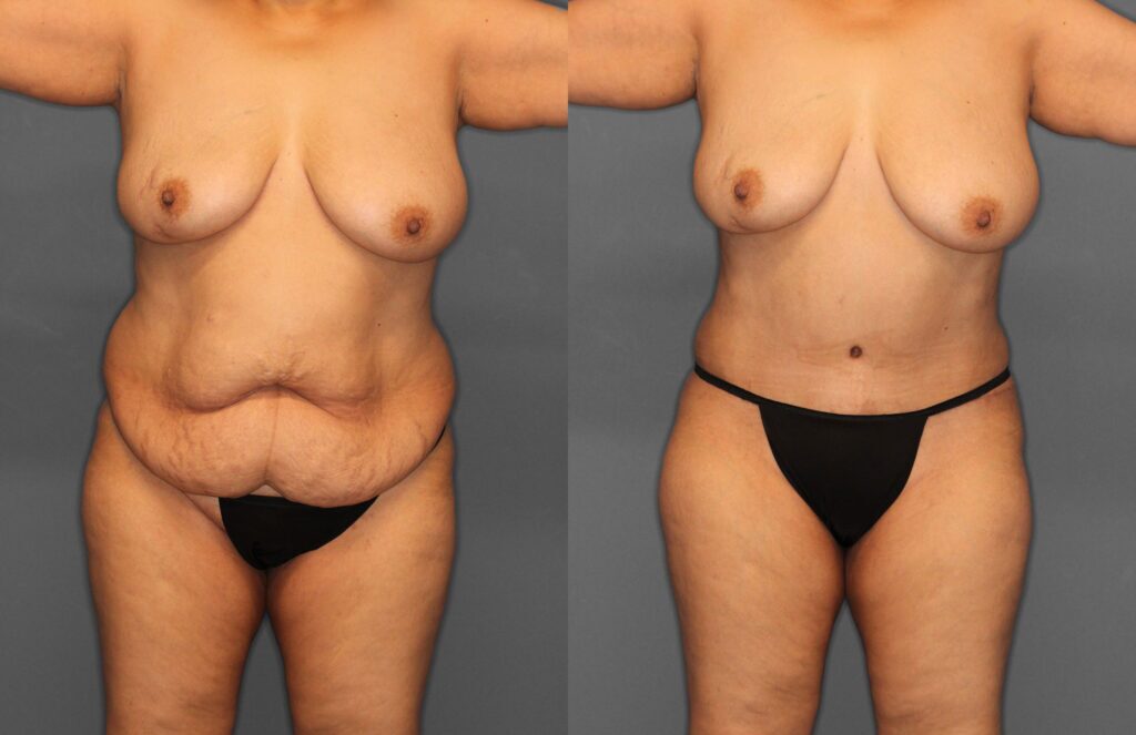 Tummy Tuck Before and After photo by Dr. Abigail Rodriguez in Houston, TX