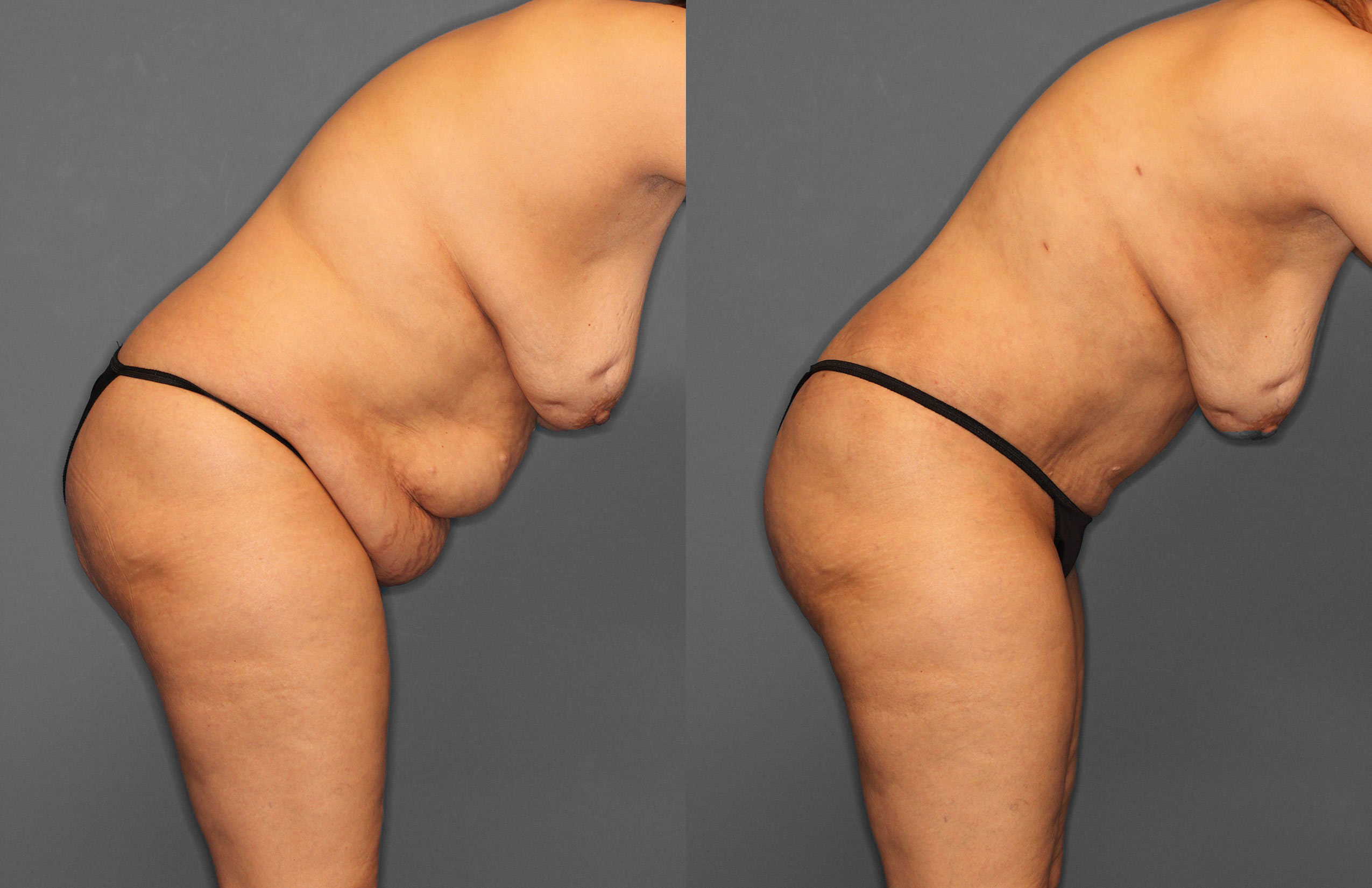Tummy Tuck Before and After photo by Dr. Abigail Rodriguez in Houston, TX