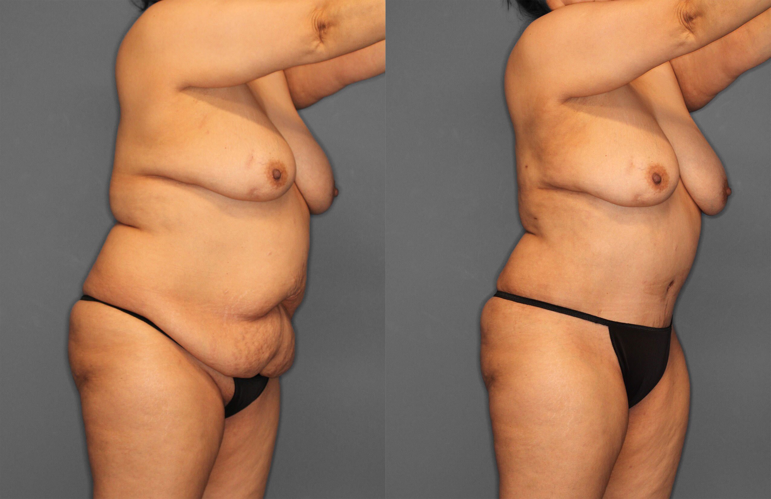 Tummy Tuck Before and After photo by Dr. Abigail Rodriguez in Houston, TX