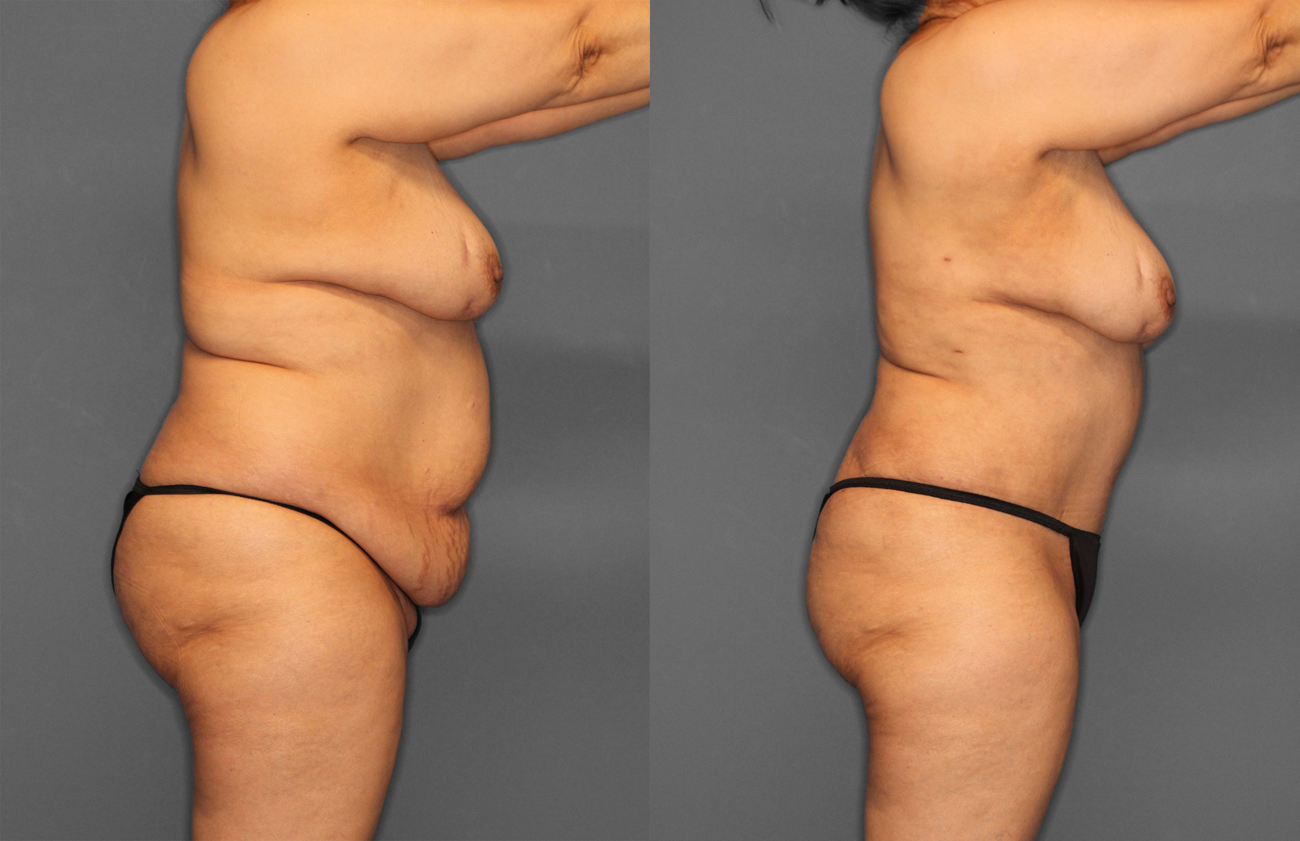 Tummy Tuck Before and After photo by Dr. Abigail Rodriguez in Houston, TX