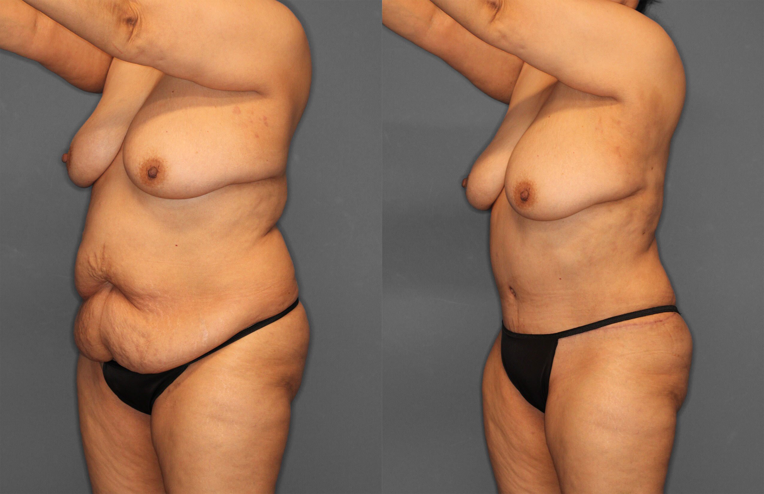 Tummy Tuck Before and After photo by Dr. Abigail Rodriguez in Houston, TX