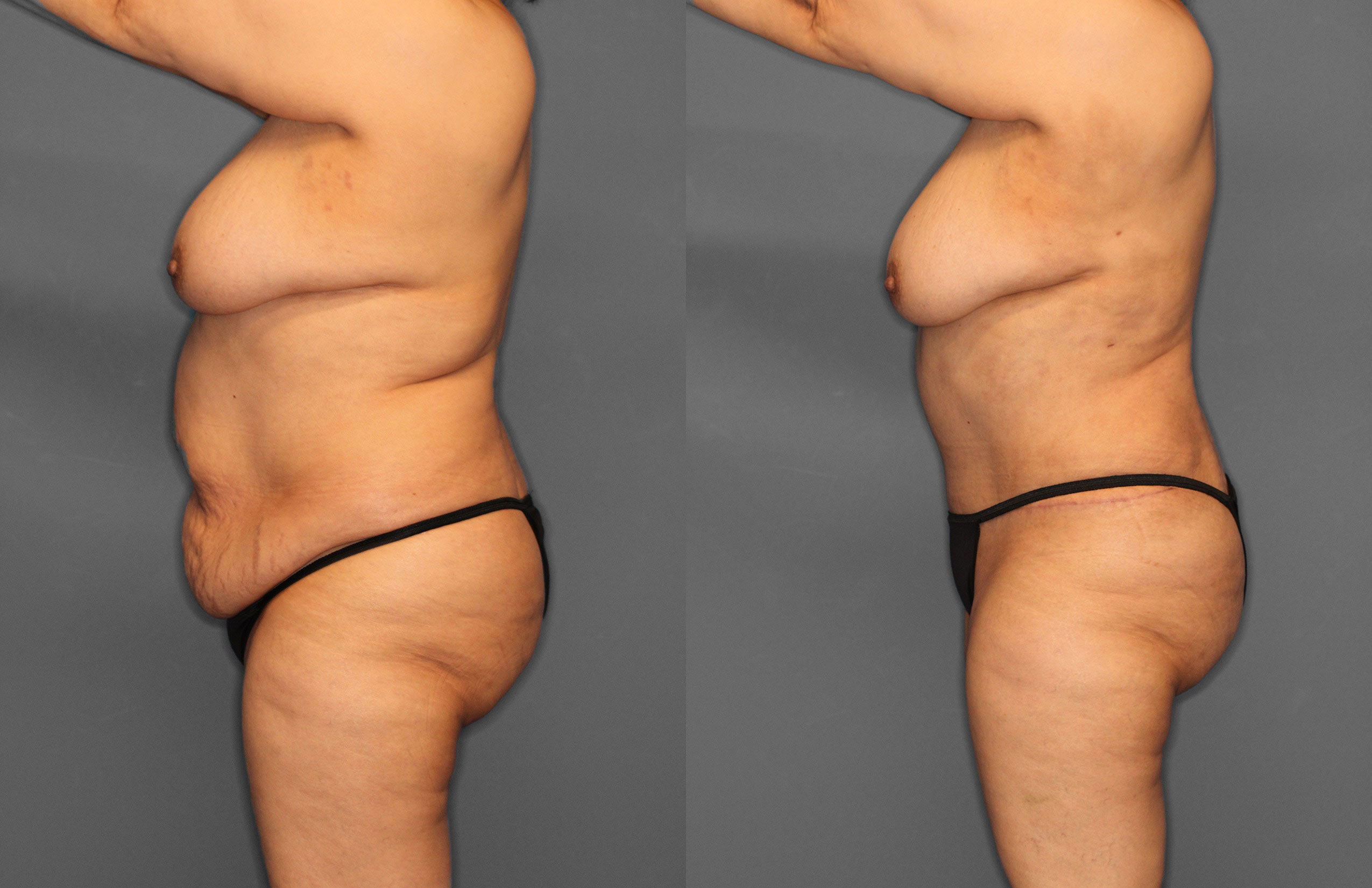 Tummy Tuck Before and After photo by Dr. Abigail Rodriguez in Houston, TX