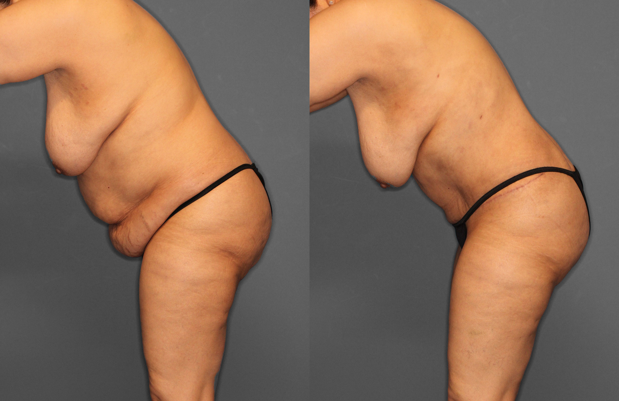 Tummy Tuck Before and After photo by Dr. Abigail Rodriguez in Houston, TX