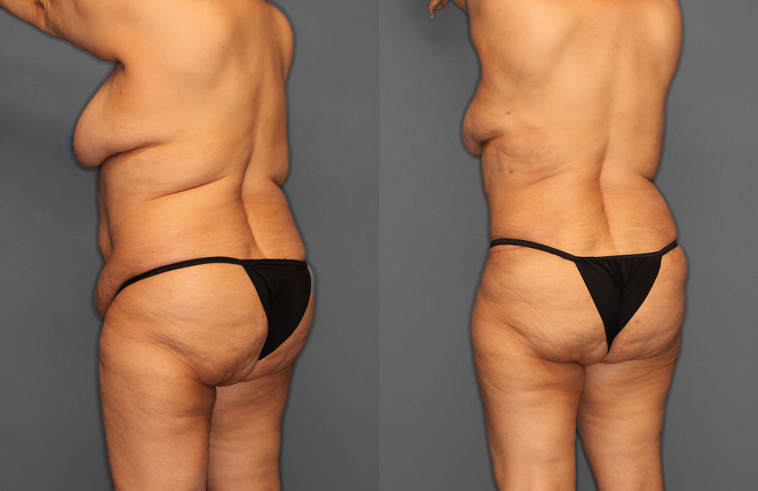 Tummy Tuck Before and After photo by Dr. Abigail Rodriguez in Houston, TX