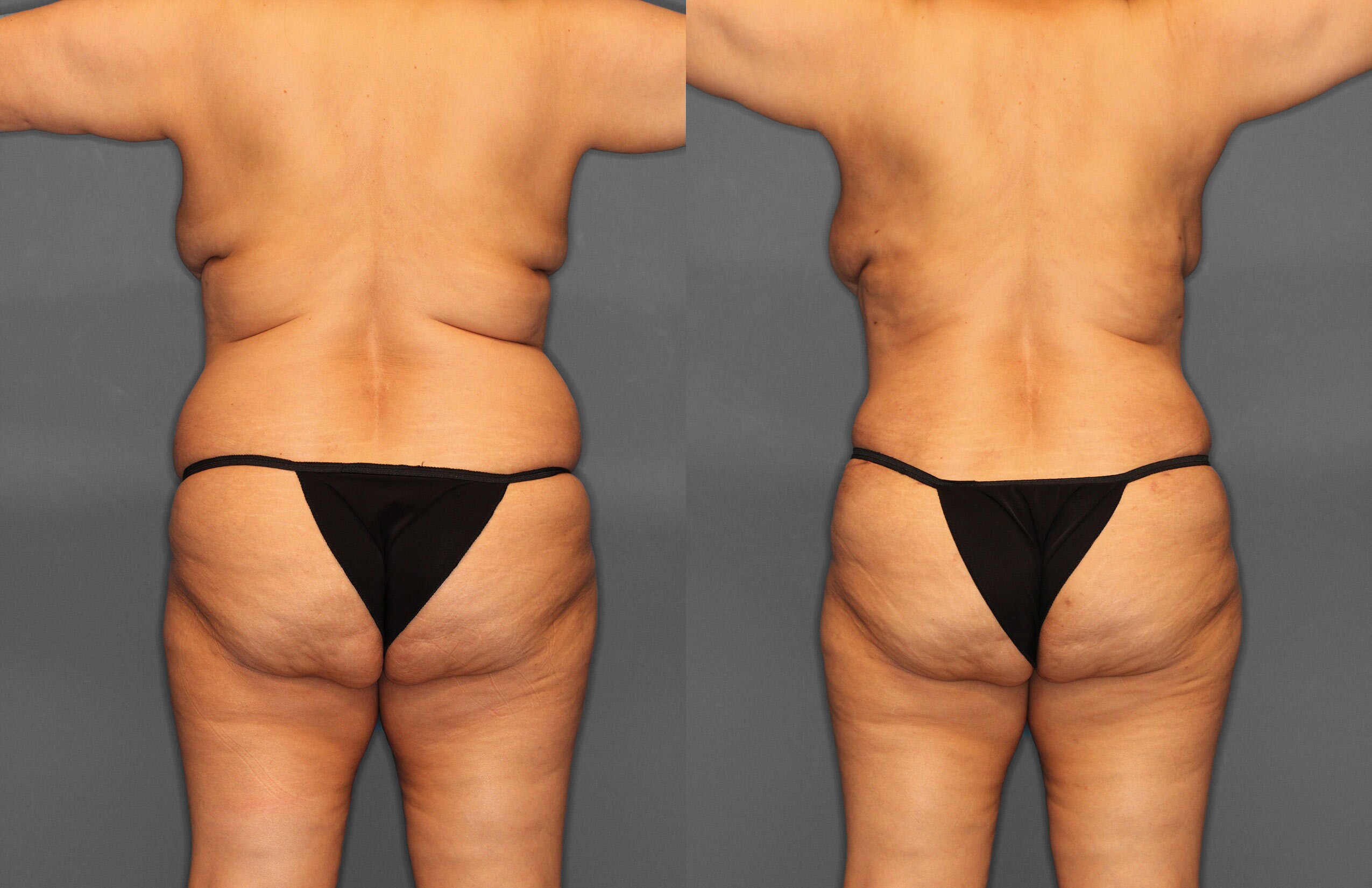 Tummy Tuck Before and After photo by Dr. Abigail Rodriguez in Houston, TX