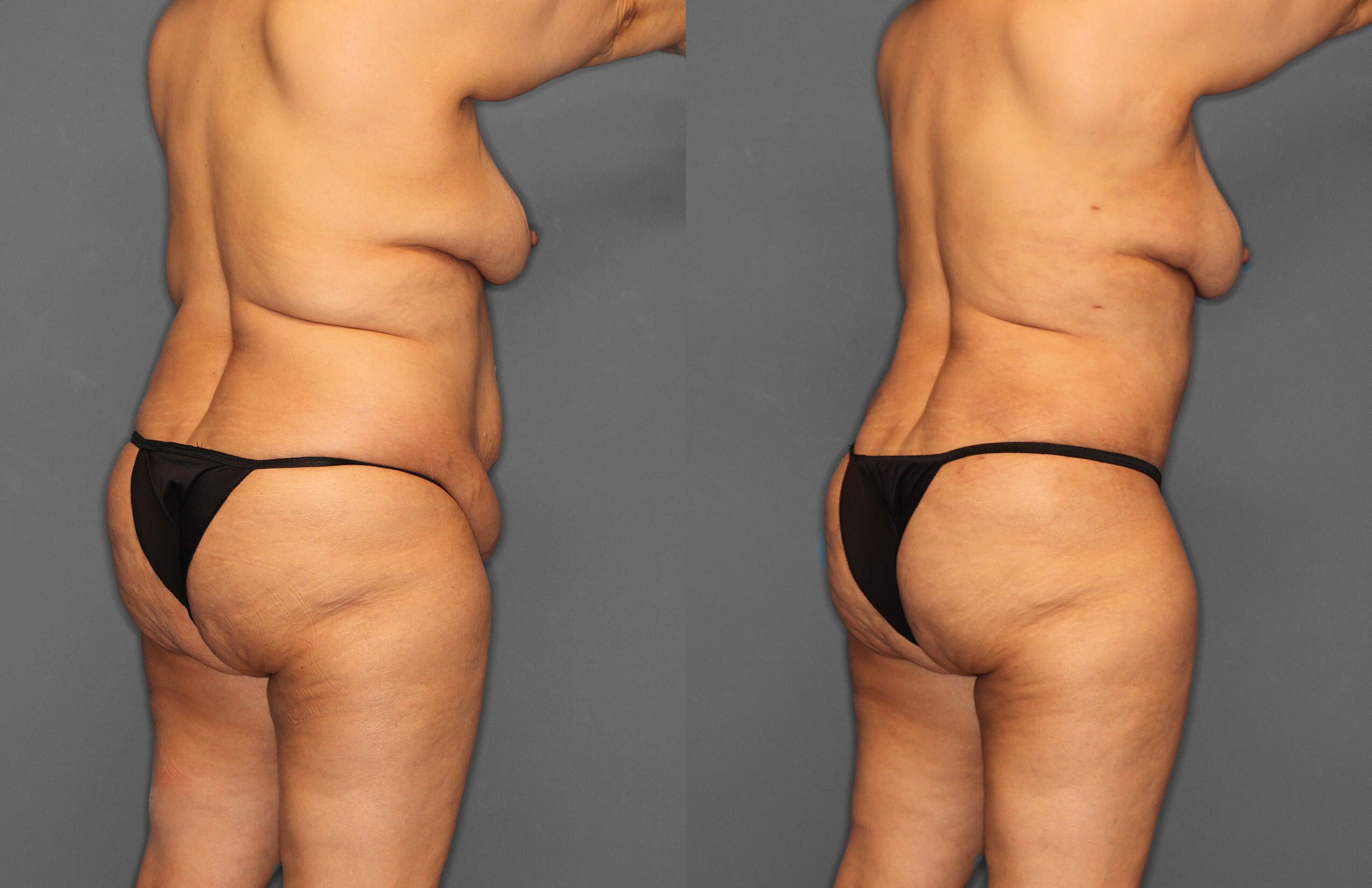 Tummy Tuck Before and After photo by Dr. Abigail Rodriguez in Houston, TX