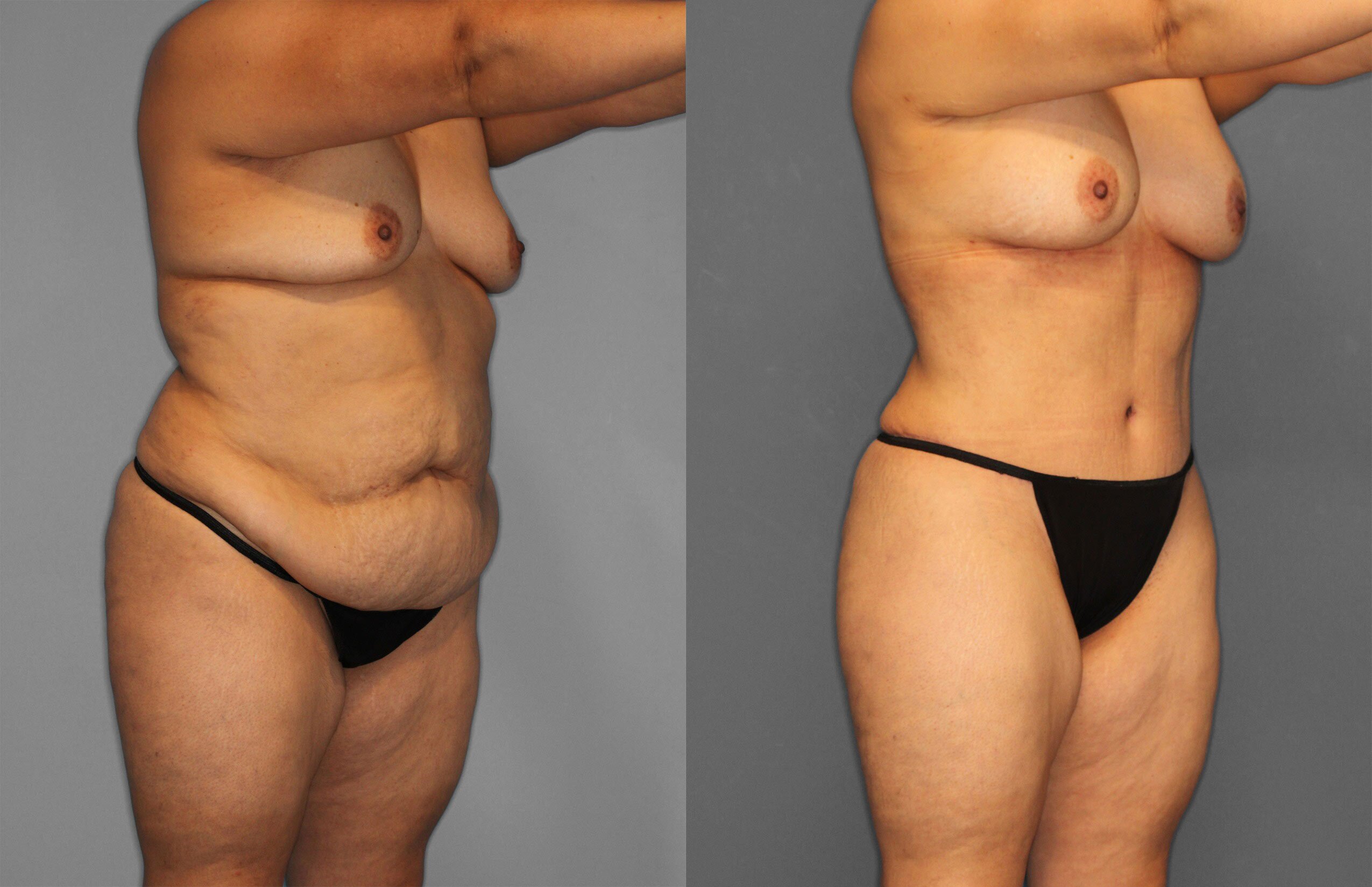 Tummy Tuck Before and After photo by Dr. Abigail Rodriguez in Houston, TX