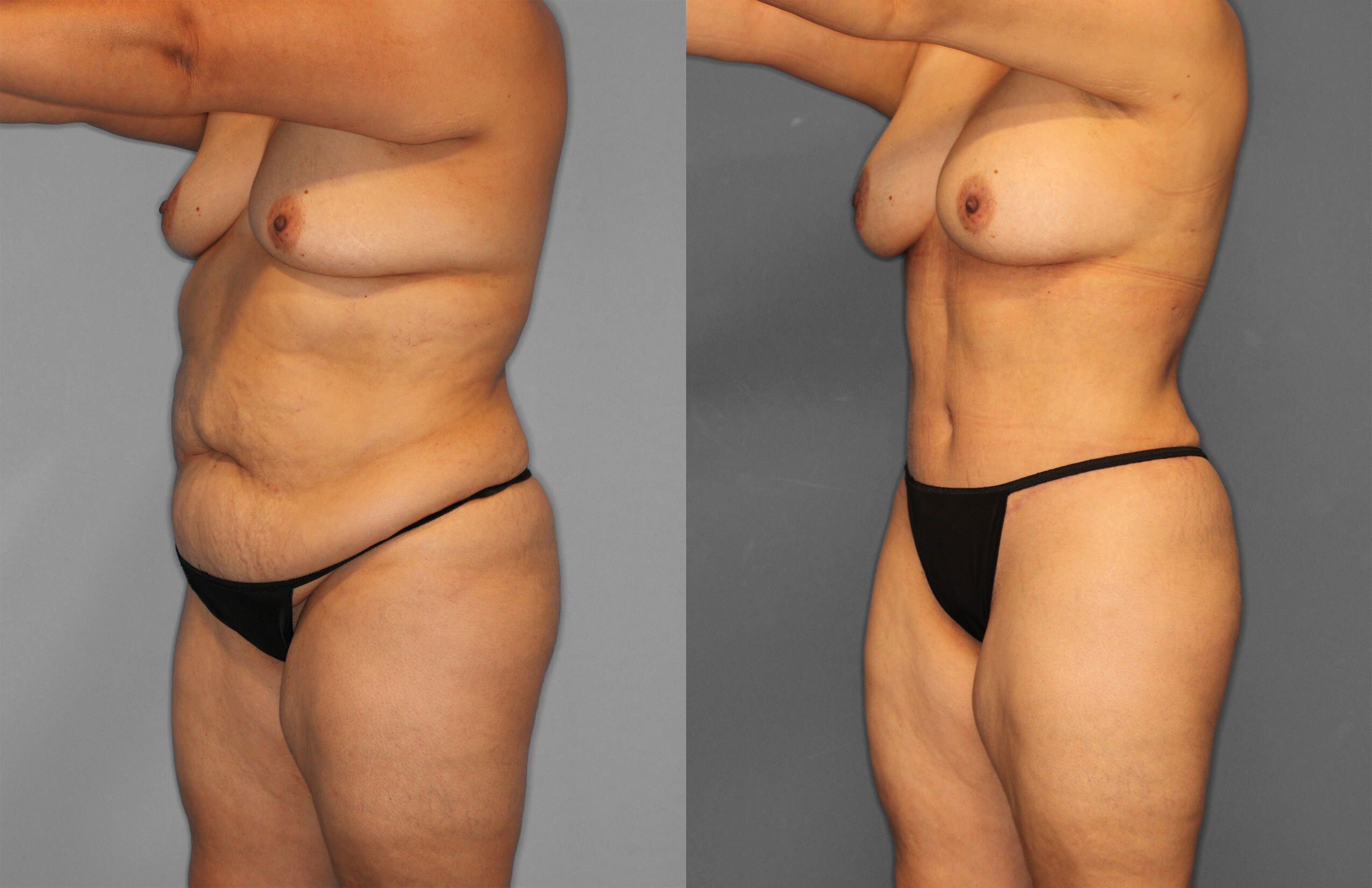 Tummy Tuck Before and After photo by Dr. Abigail Rodriguez in Houston, TX