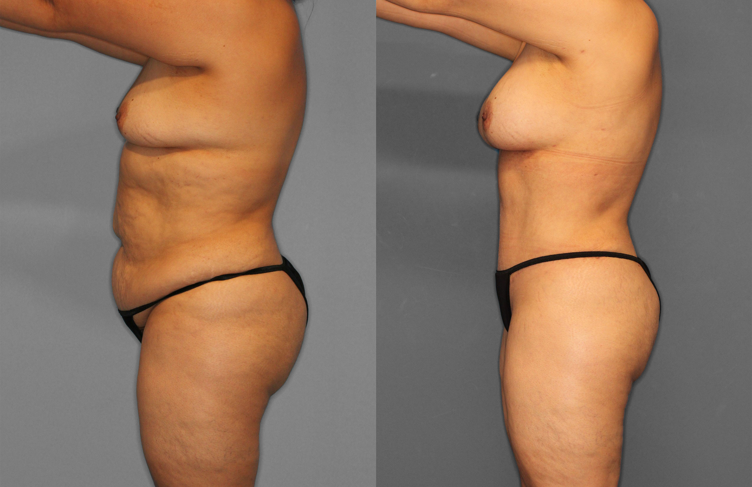 Tummy Tuck Before and After photo by Dr. Abigail Rodriguez in Houston, TX