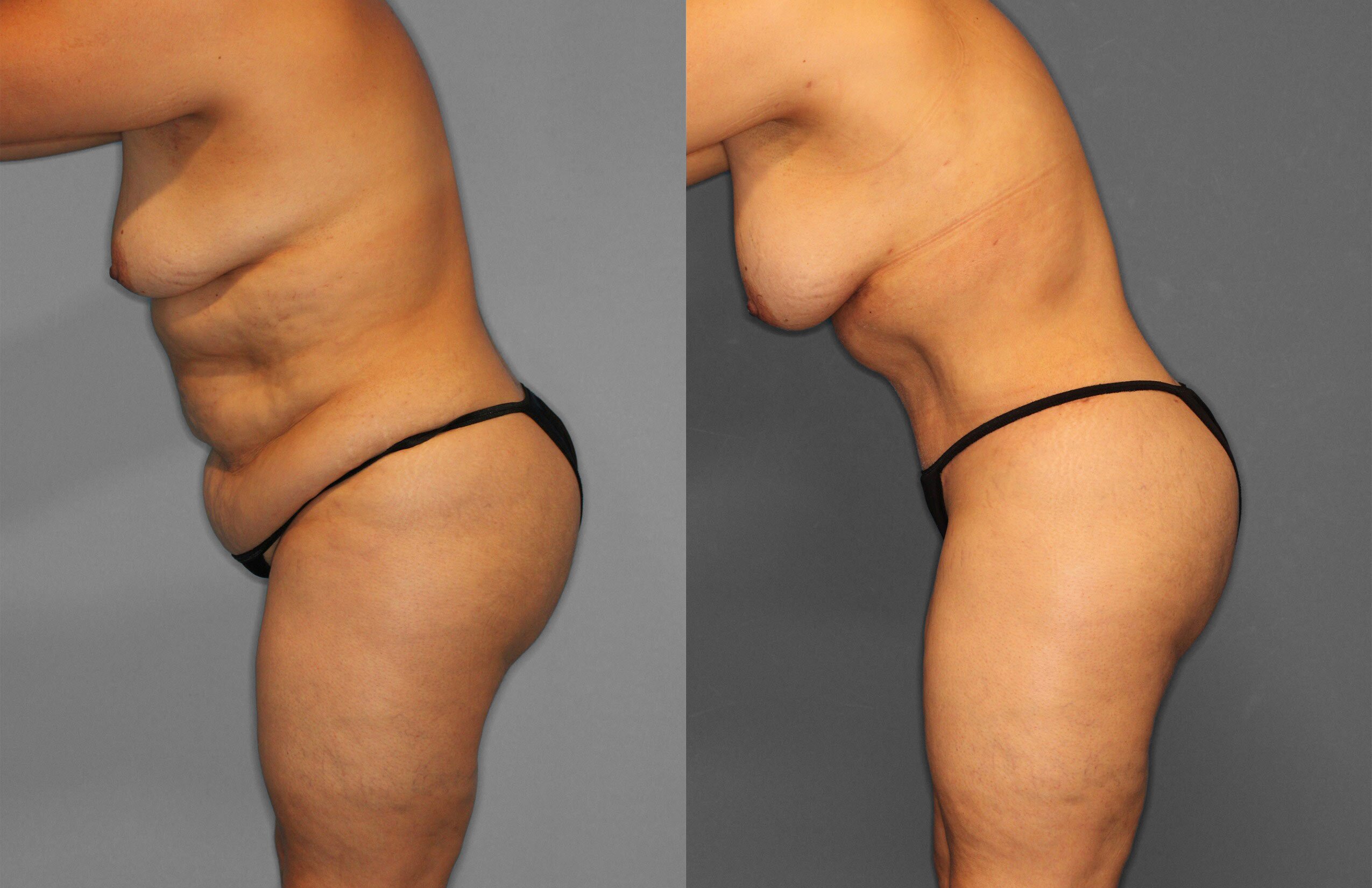 Tummy Tuck Before and After photo by Dr. Abigail Rodriguez in Houston, TX