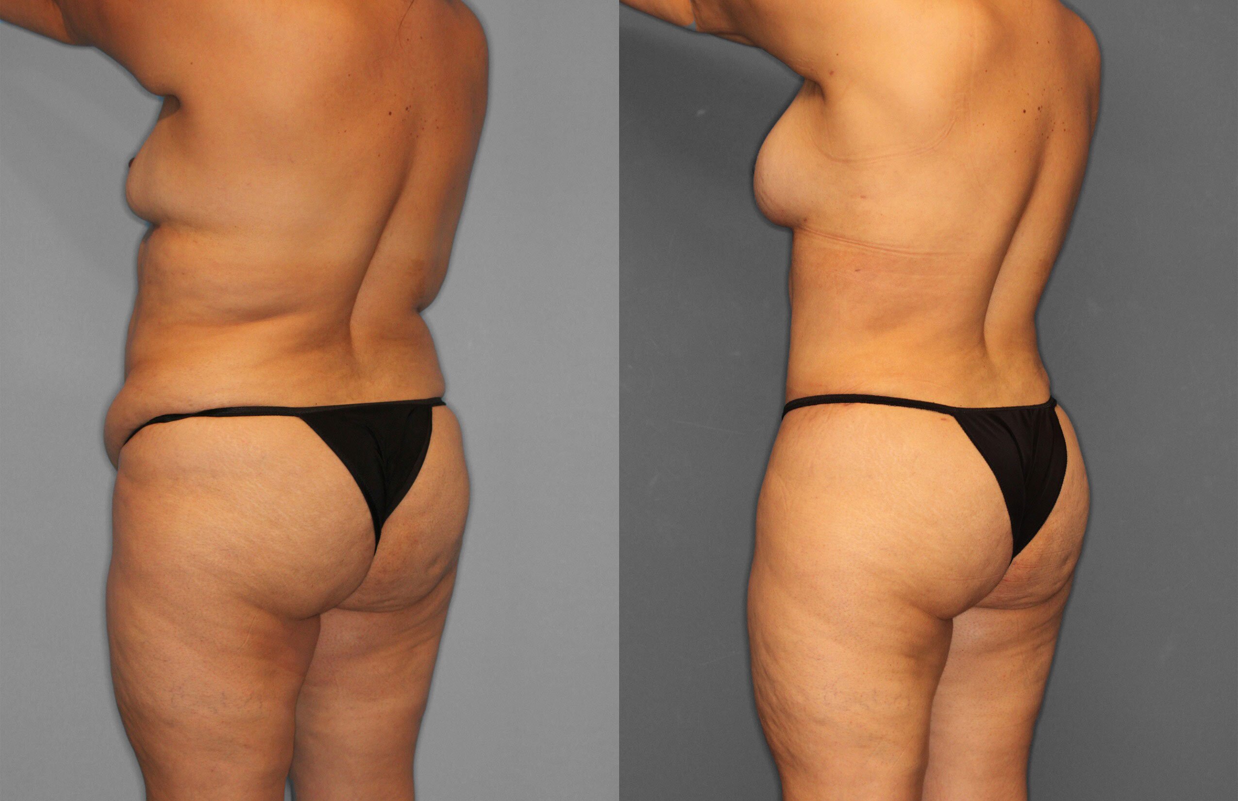 Tummy Tuck Before and After photo by Dr. Abigail Rodriguez in Houston, TX