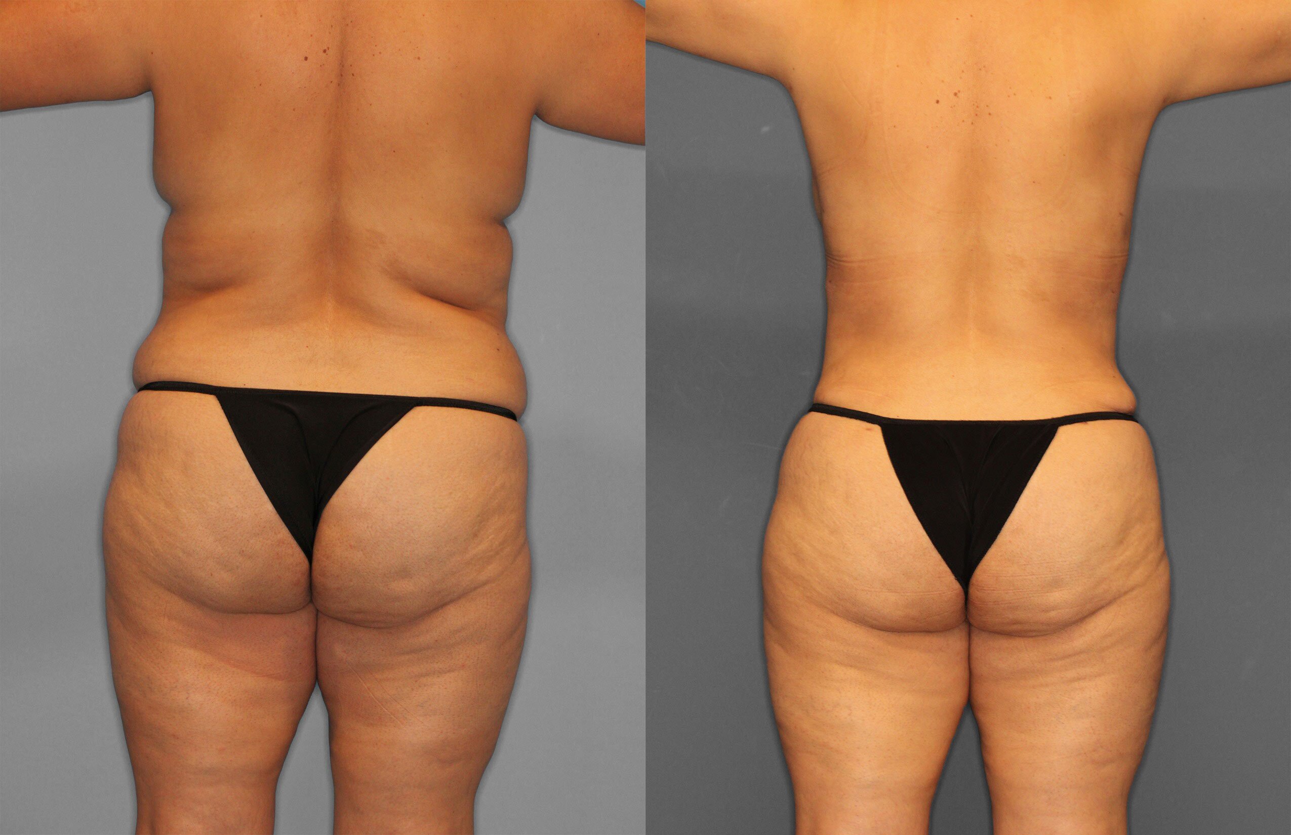 Tummy Tuck Before and After photo by Dr. Abigail Rodriguez in Houston, TX