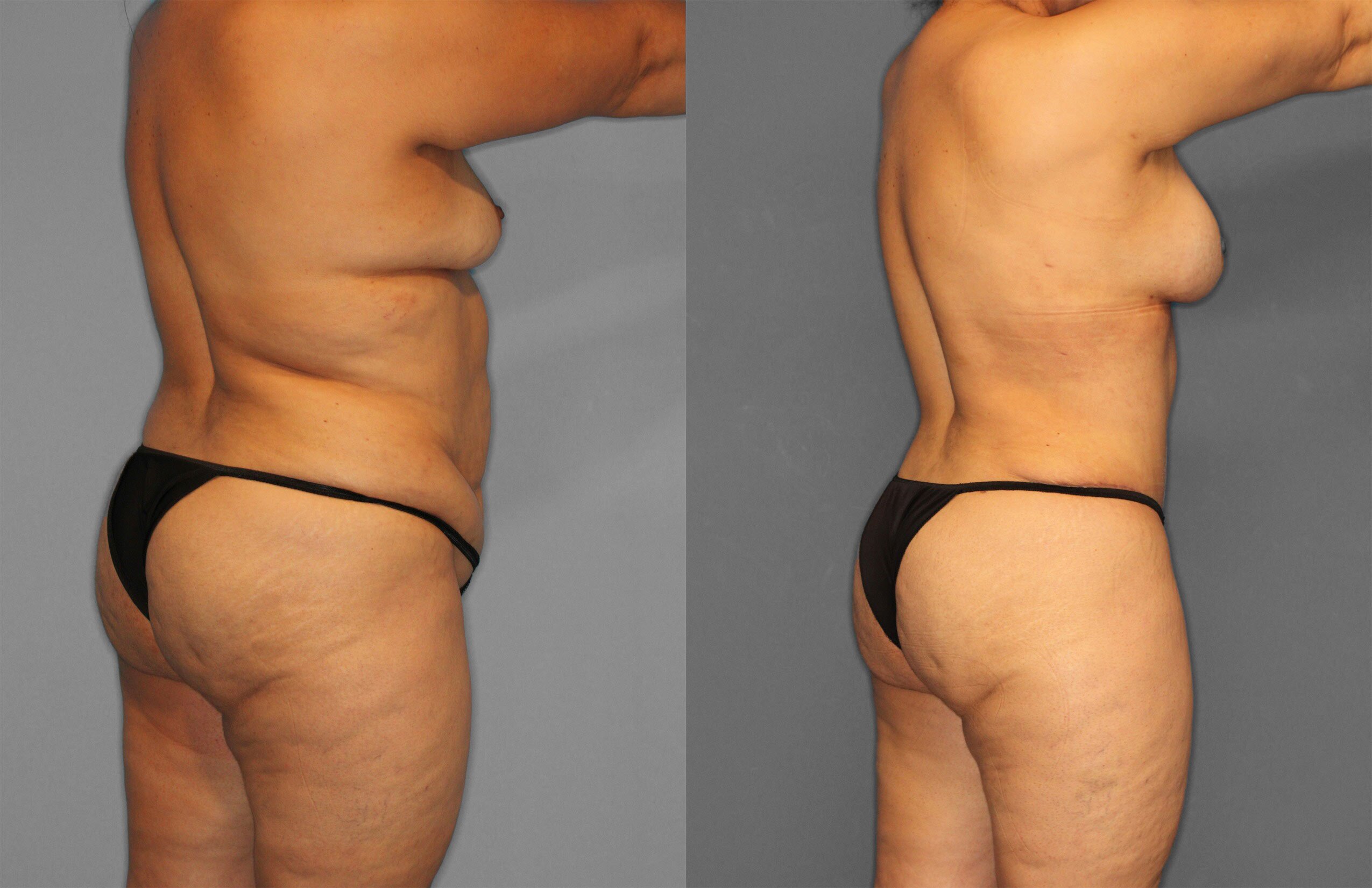 Tummy Tuck Before and After photo by Dr. Abigail Rodriguez in Houston, TX