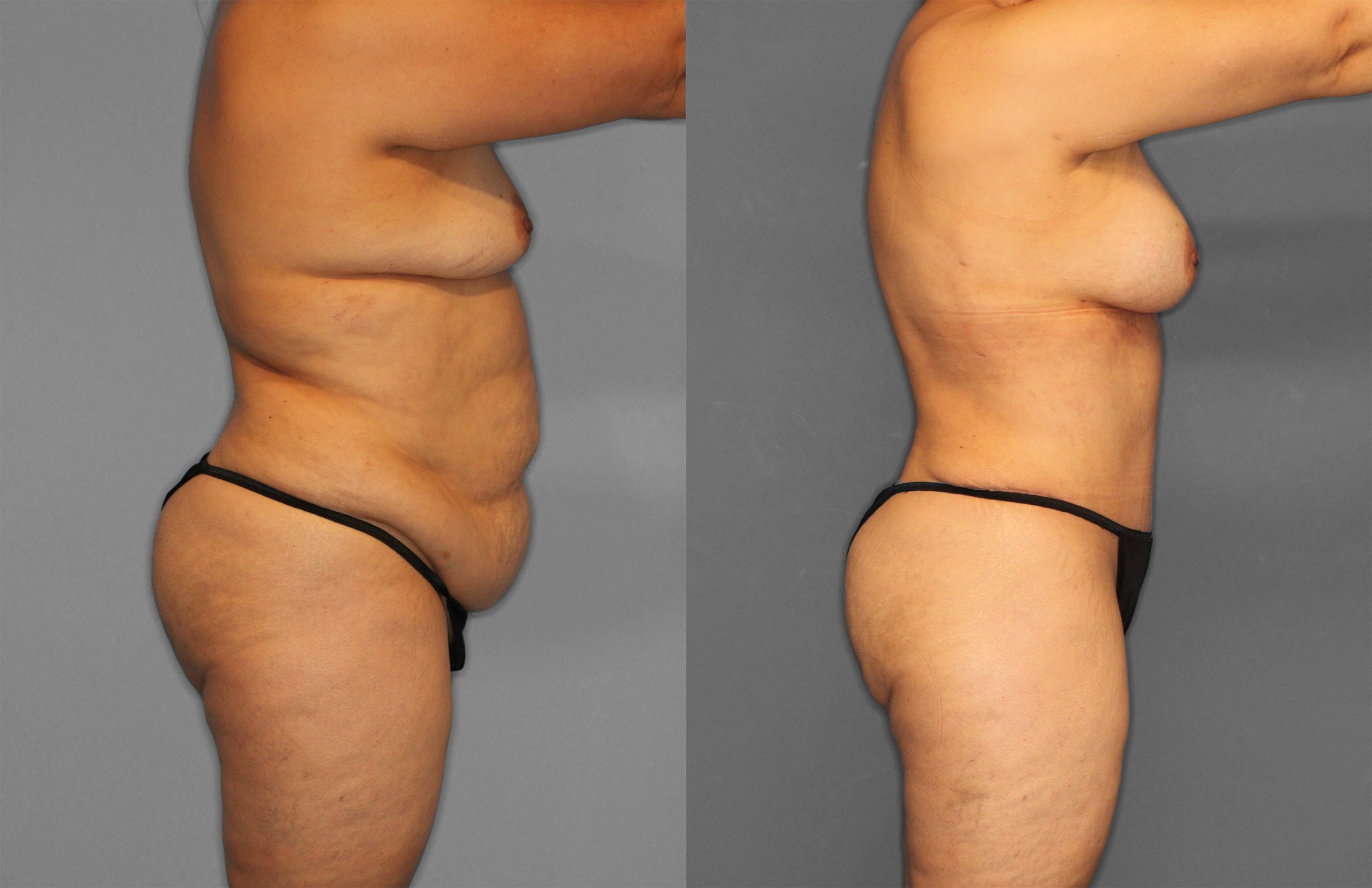 Tummy Tuck Before and After photo by Dr. Abigail Rodriguez in Houston, TX