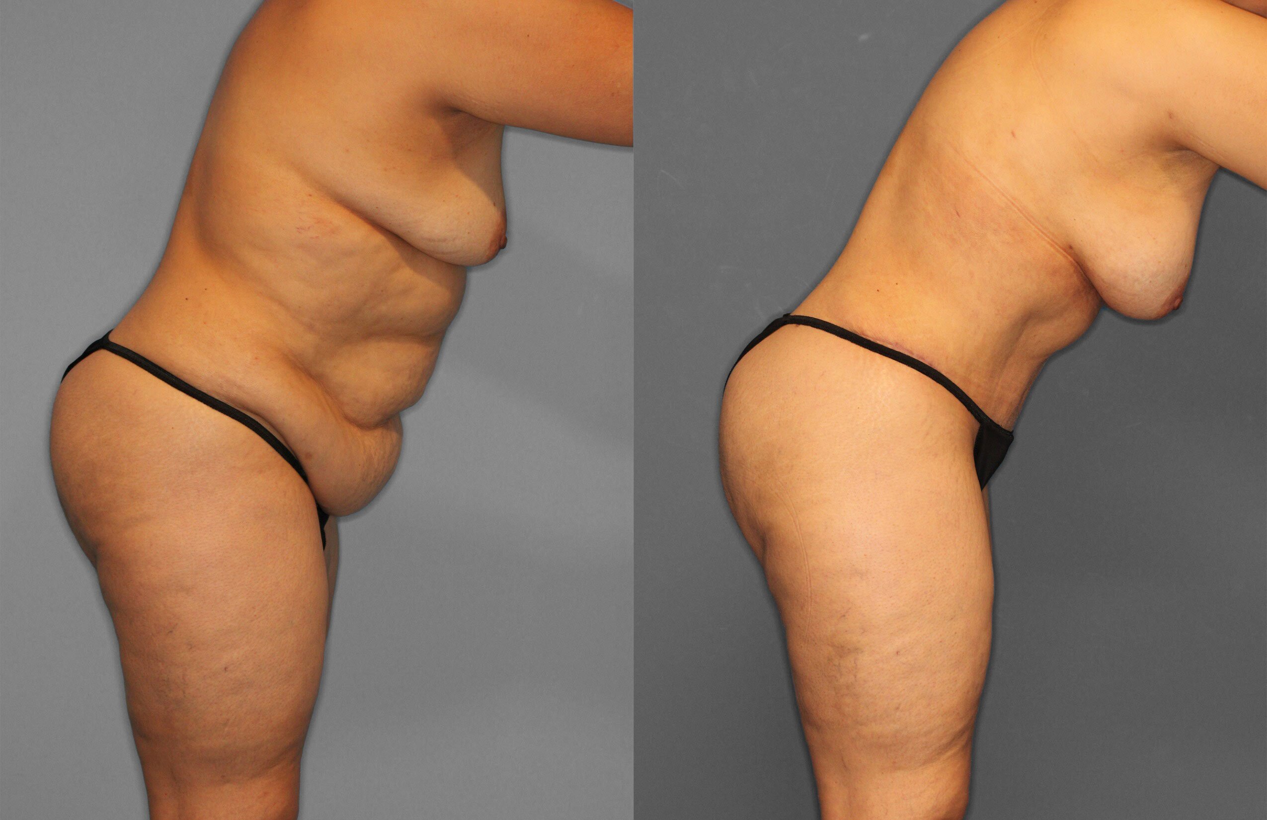Tummy Tuck Before and After photo by Dr. Abigail Rodriguez in Houston, TX