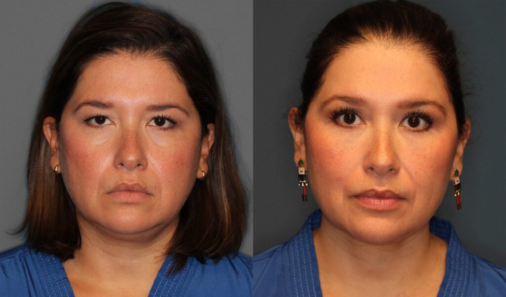 Upper Eyelid Before and After photo by Dr. Abigail Rodriguez in Houston, TX
