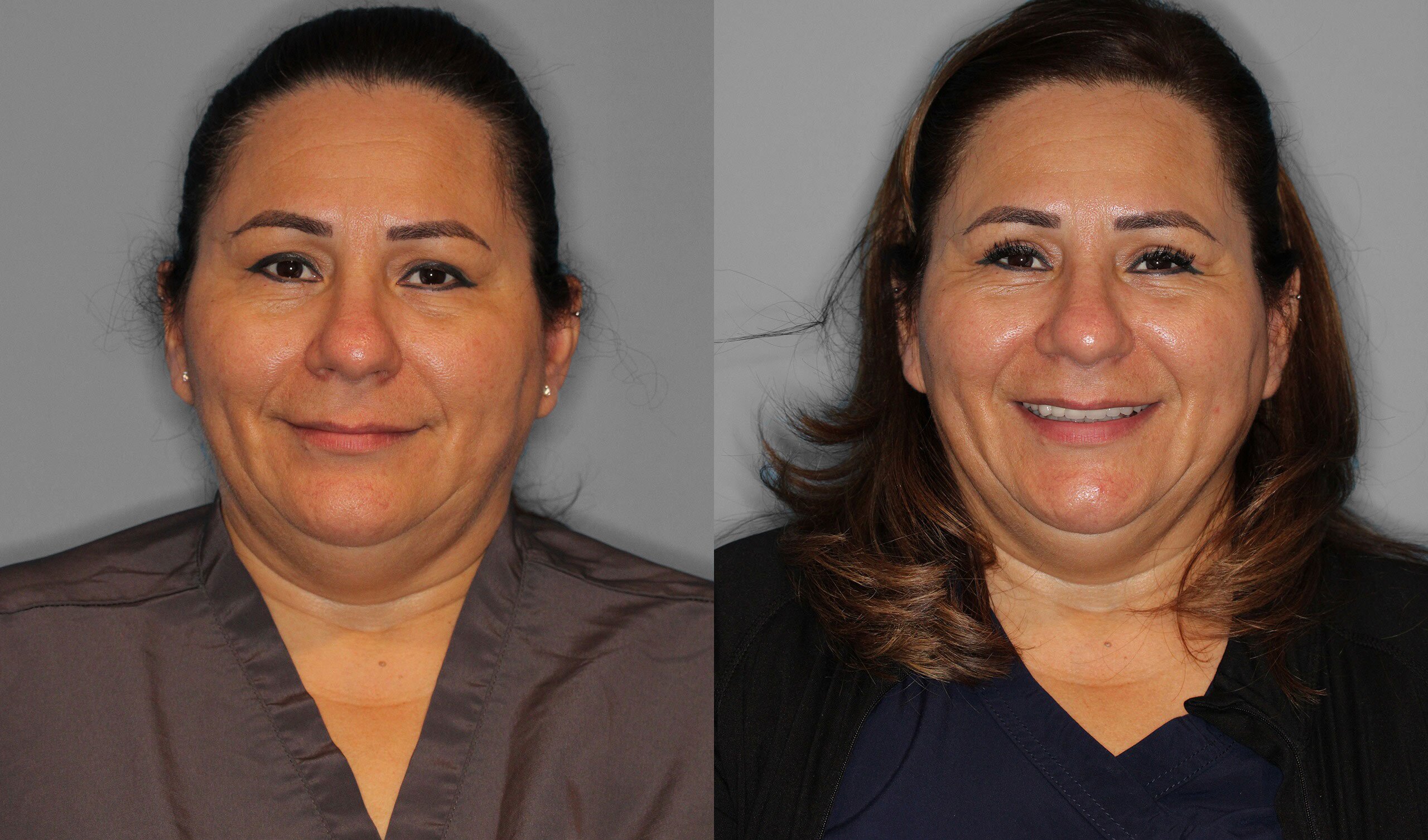 Upper Eyelid Before and After photo by Dr. Abigail Rodriguez in Houston, TX