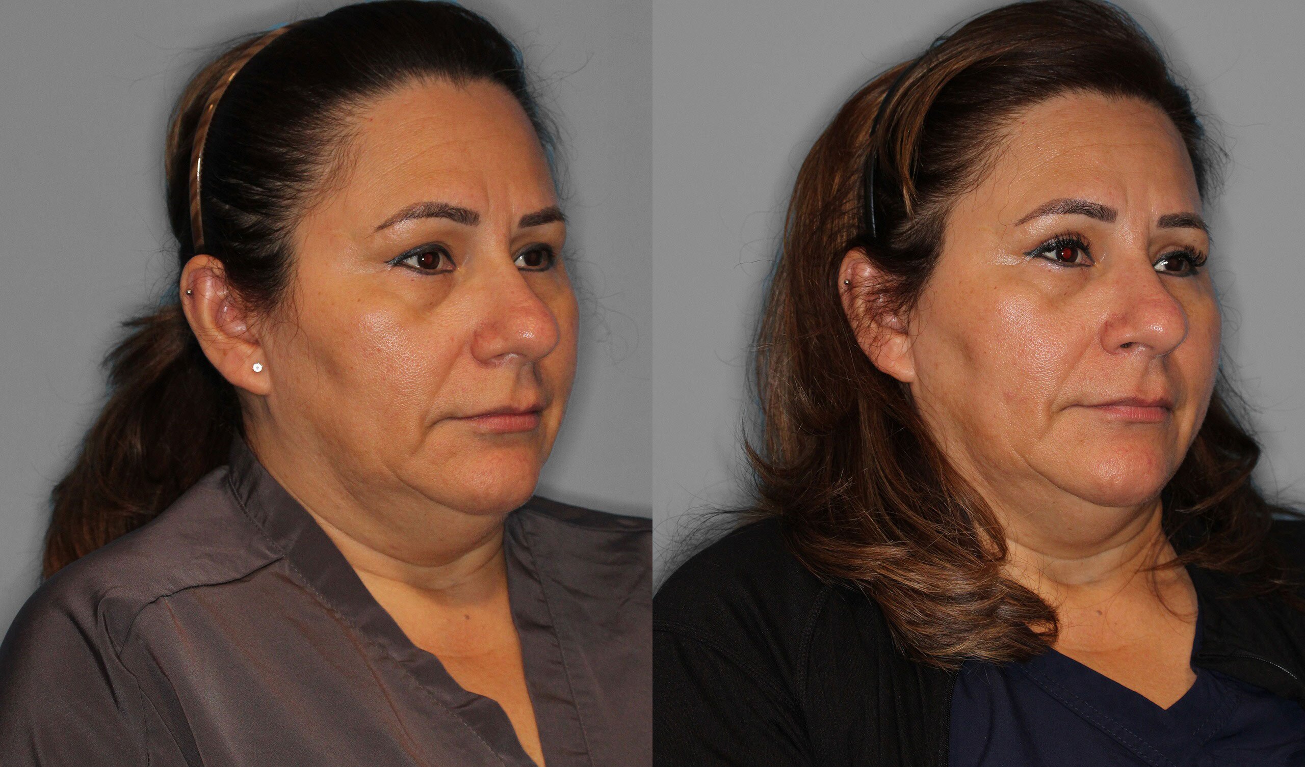 Upper Eyelid Before and After photo by Dr. Abigail Rodriguez in Houston, TX