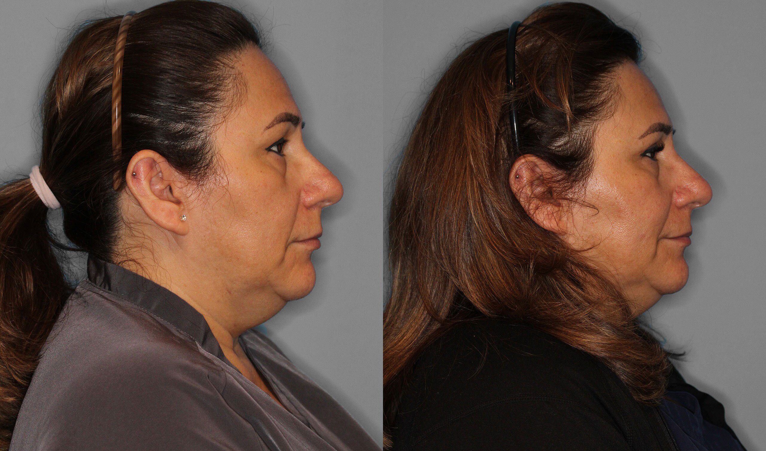 Upper Eyelid Before and After photo by Dr. Abigail Rodriguez in Houston, TX