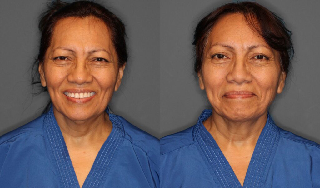 Upper Eyelid Brow Lift Before and After photo by Dr. Abigail Rodriguez in Houston, TX