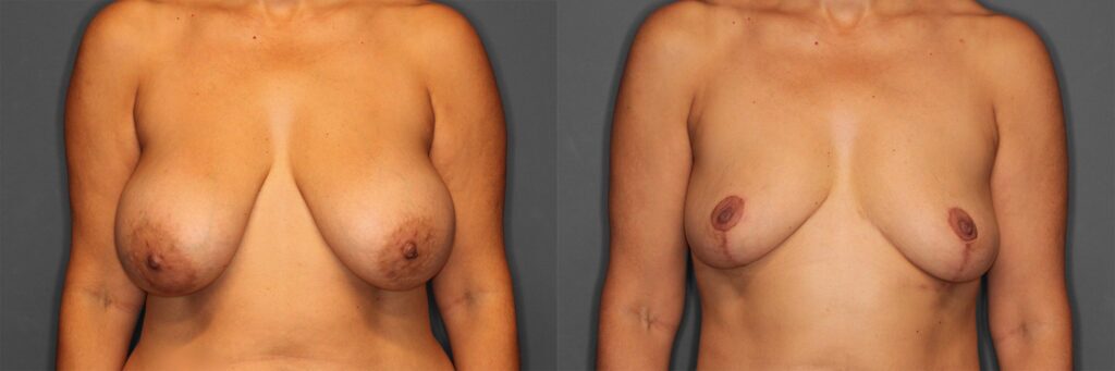 Implant Removal + Lift Before and After photo by Dr. Abigail Rodriguez in Houston, TX